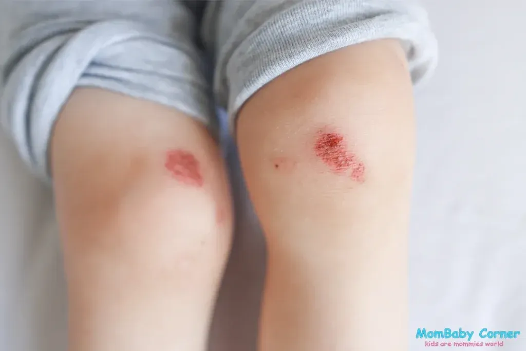 baby-injuries-and-scratches