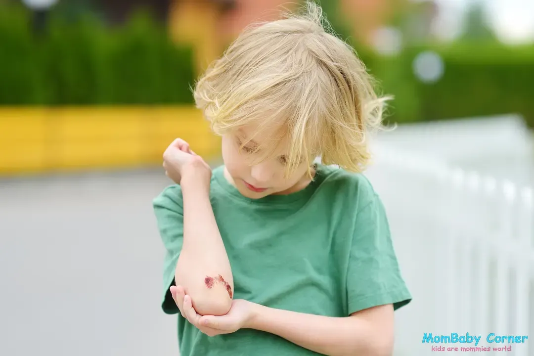 home-remedies-for-baby-injury