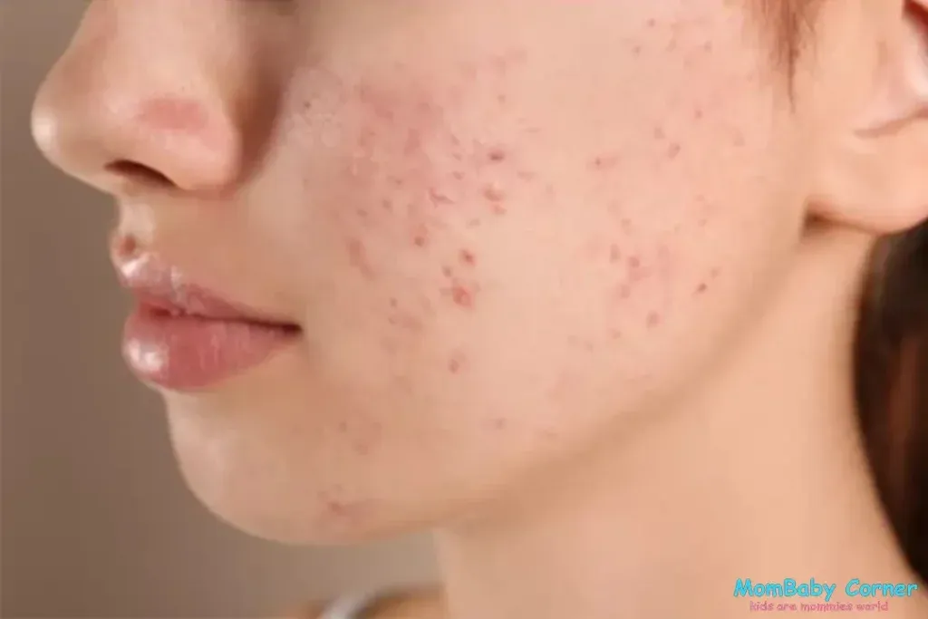 pimple face for pcod
