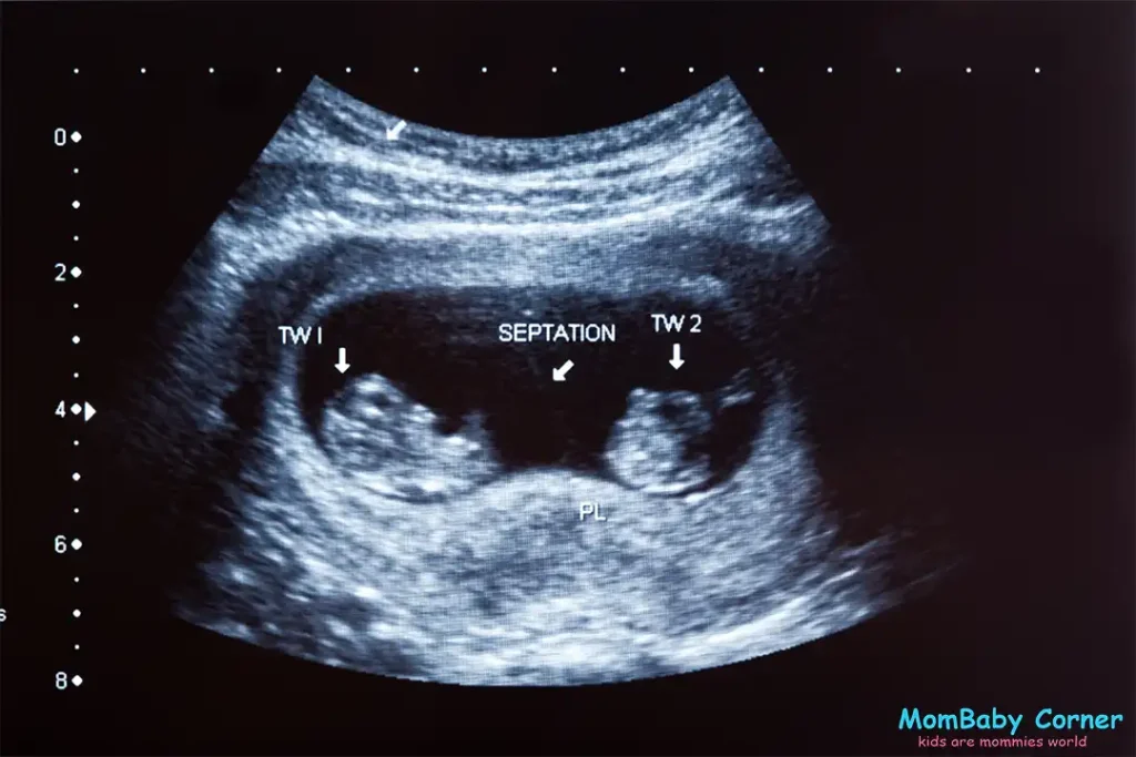 twins baby sonography